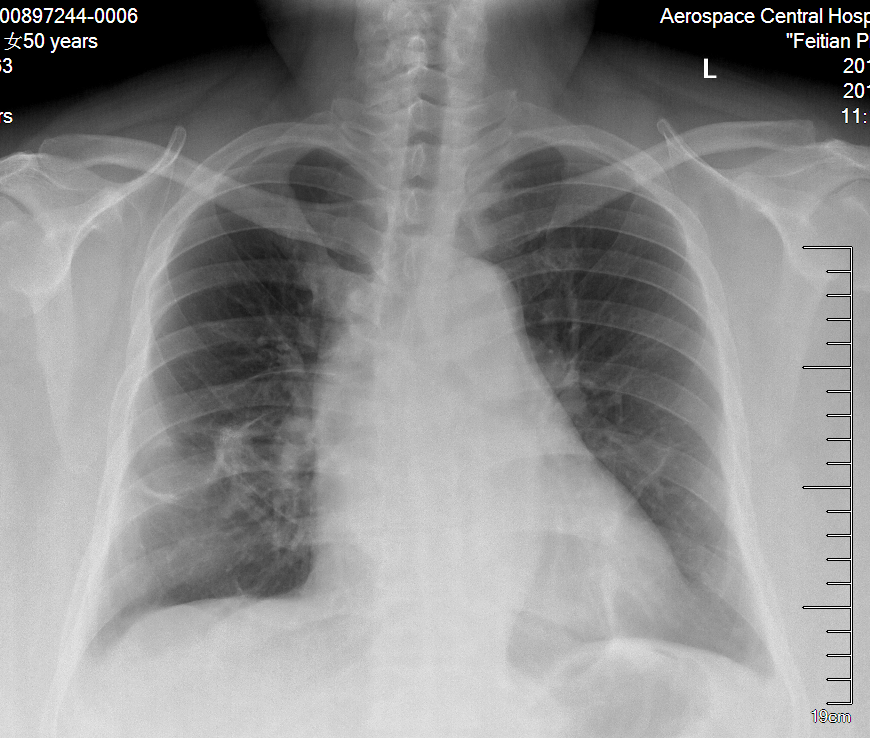双侧肺结节同期微创手术治疗