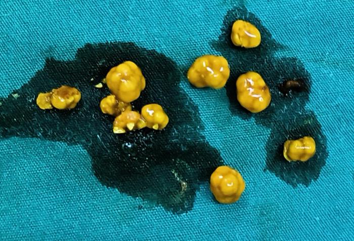 无症状胆囊结石怎么办 - 微医(挂号网)