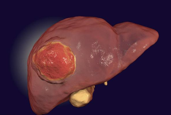 27岁小伙肝癌晚期,最伤肝的3个习惯,很多人1个也改不掉!