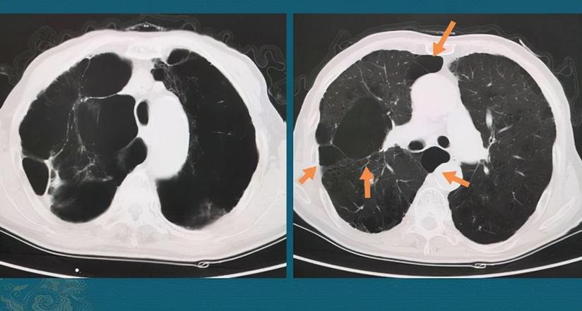 怎样保养能让肺大泡长得慢一点 怎样避免肺大泡破裂变成气胸 健康号 微医