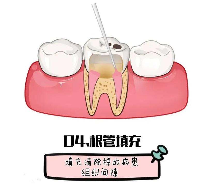 牙齿 根管治疗后为什么还需要做全冠保护 健康号 微医