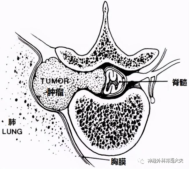 颈椎哑铃状肿瘤的治疗特别具有挑战性,因为其独特的暴露要求,椎动脉的
