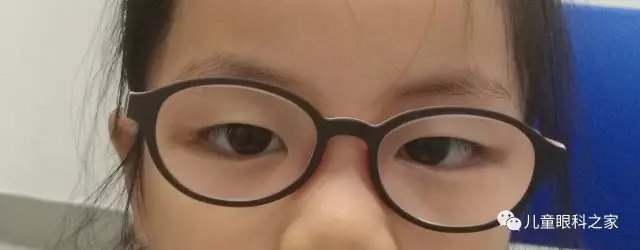 亲戚邻居朋友都说我家宝宝是斗鸡眼