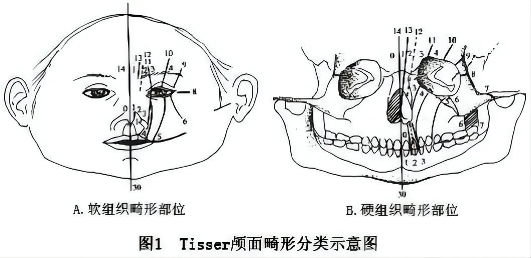 先天性面裂鼻畸形的诊断与治疗