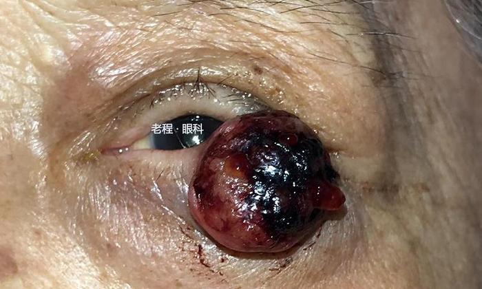 眼睑恶性肿瘤系列之鳞状细胞癌_程金伟医生文章_复旦大学附属眼耳鼻喉