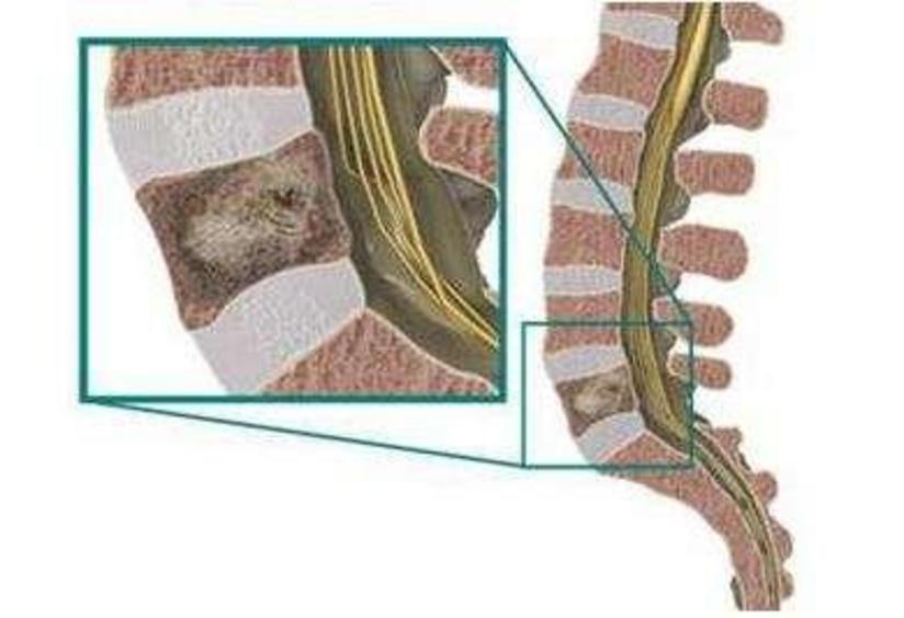 脊柱也会发生肿瘤 别把腰背痛不当回事 健康号 微医