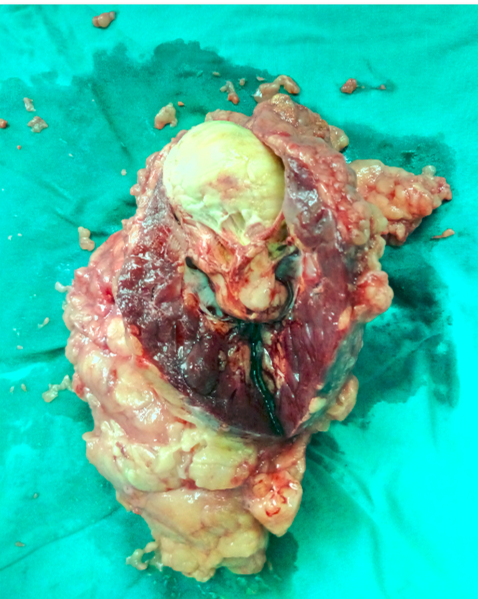 乳头状肾细胞癌,透明细胞癌,双侧肾癌的微创治疗进展