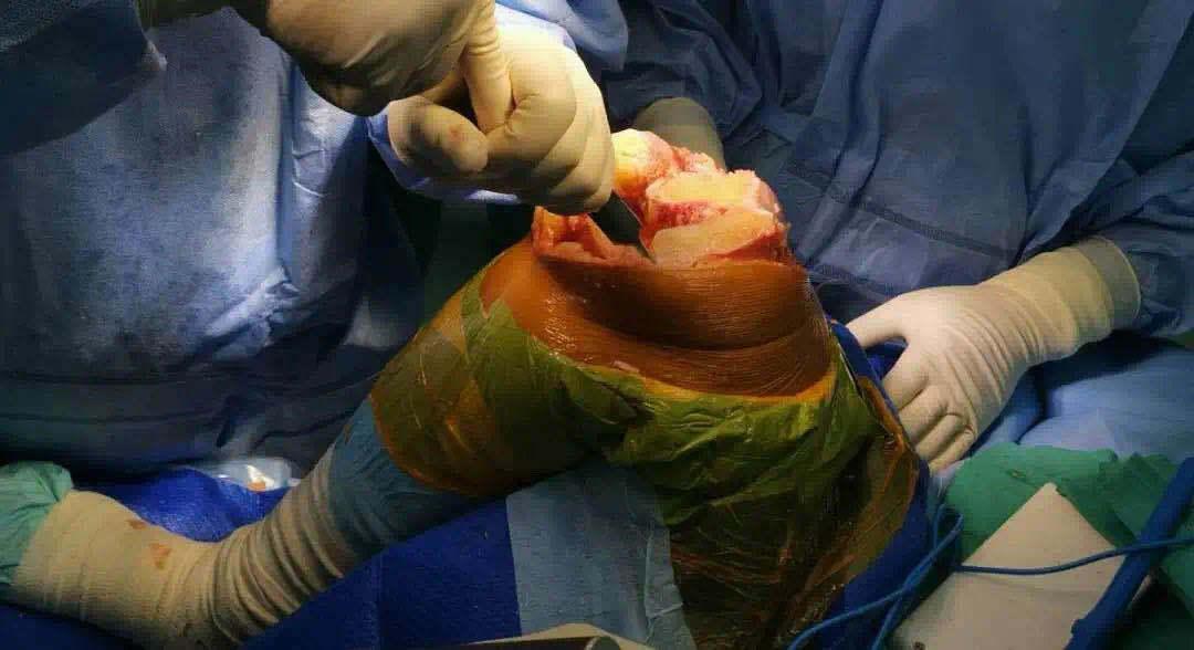 膝关节游离体手术图片