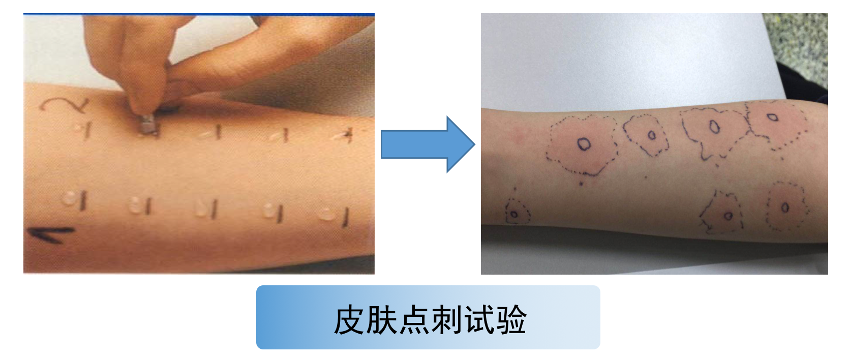 一是皮肤点刺试验:在前臂皮肤上依次滴加不同过敏原,用点刺针轻轻刺入