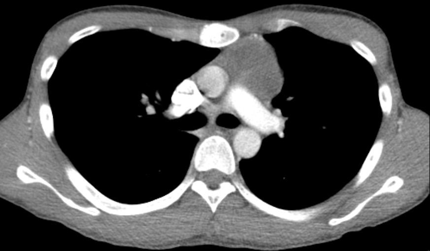 前纵隔结节前纵隔肿块胸腺囊肿thymiccyst和胸腺瘤如何区别需要手术吗