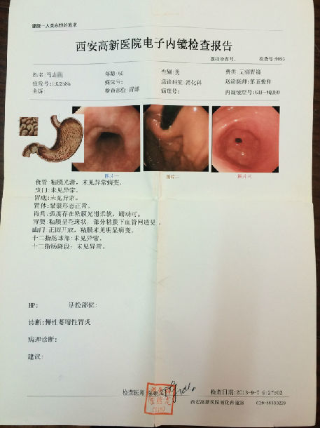 膏方治疗萎缩性胃炎患者的胃镜病理前后对照图片