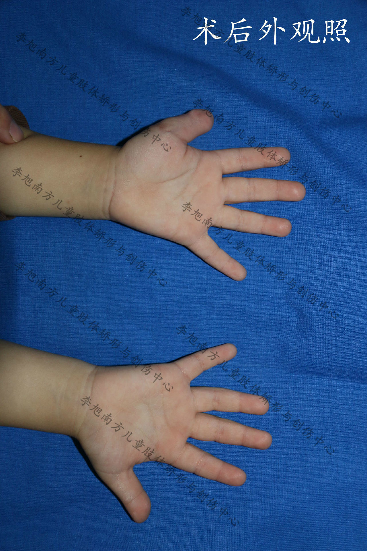 我院儿童骨科每年都会接收患有多指畸形的孩子,大部分的家长都愿意