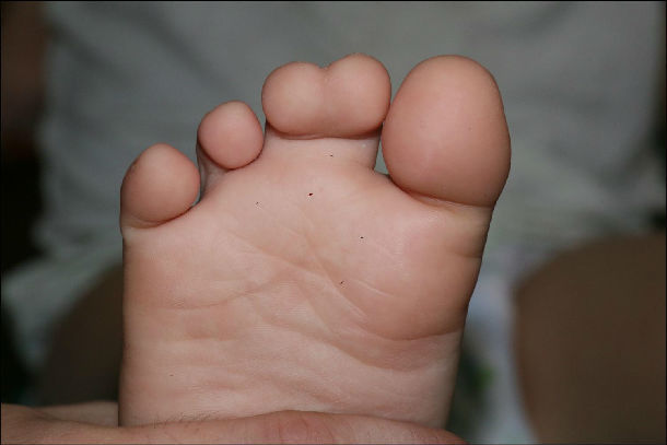 原创先天性多趾并趾畸形的治疗