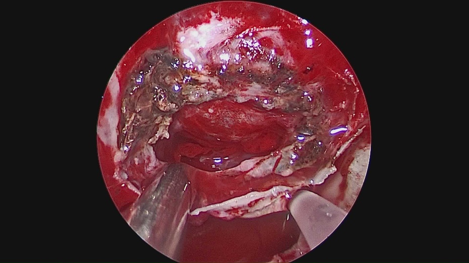 贺晓生教授垂体瘤经蝶翼免开颅手术治疗实例
