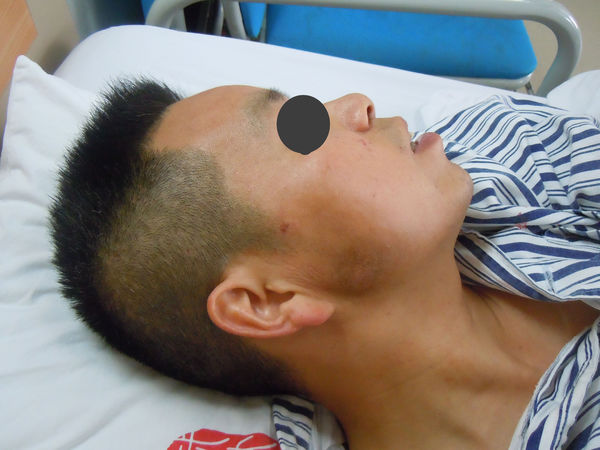 慢性腮腺炎转化为腮腺脓肿有图片