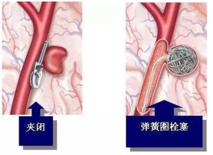 专家回答动脉瘤患者的常见问题 健康号 微医