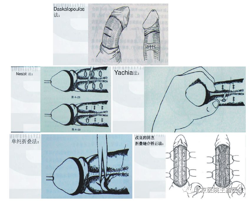 第一种是,当阴茎长度足够时,从弯曲凸出部分折叠缝合阴茎白膜矫正弯曲