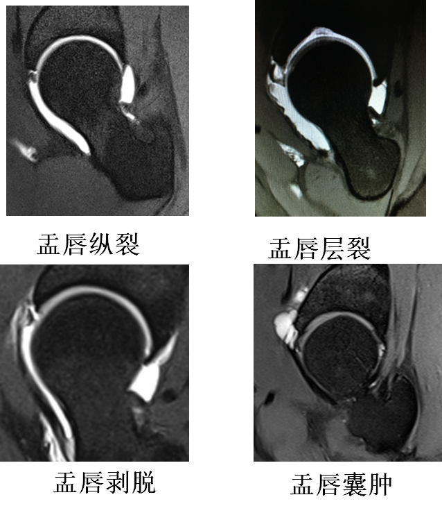 临床表现髋臼盂唇撕裂典型的临床表现为髋部疼痛,多位于腹股沟处,也可