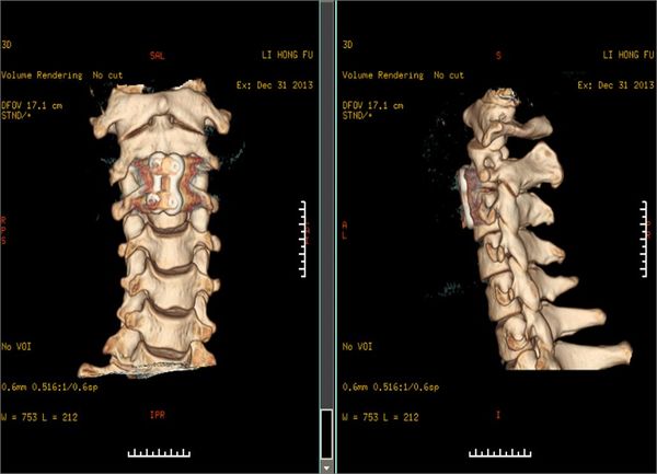 颈椎骨折的手术治疗颈2椎弓根骨折