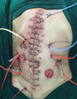 车祸伤十二指肠瘘腹腔感染的确定性手术治疗