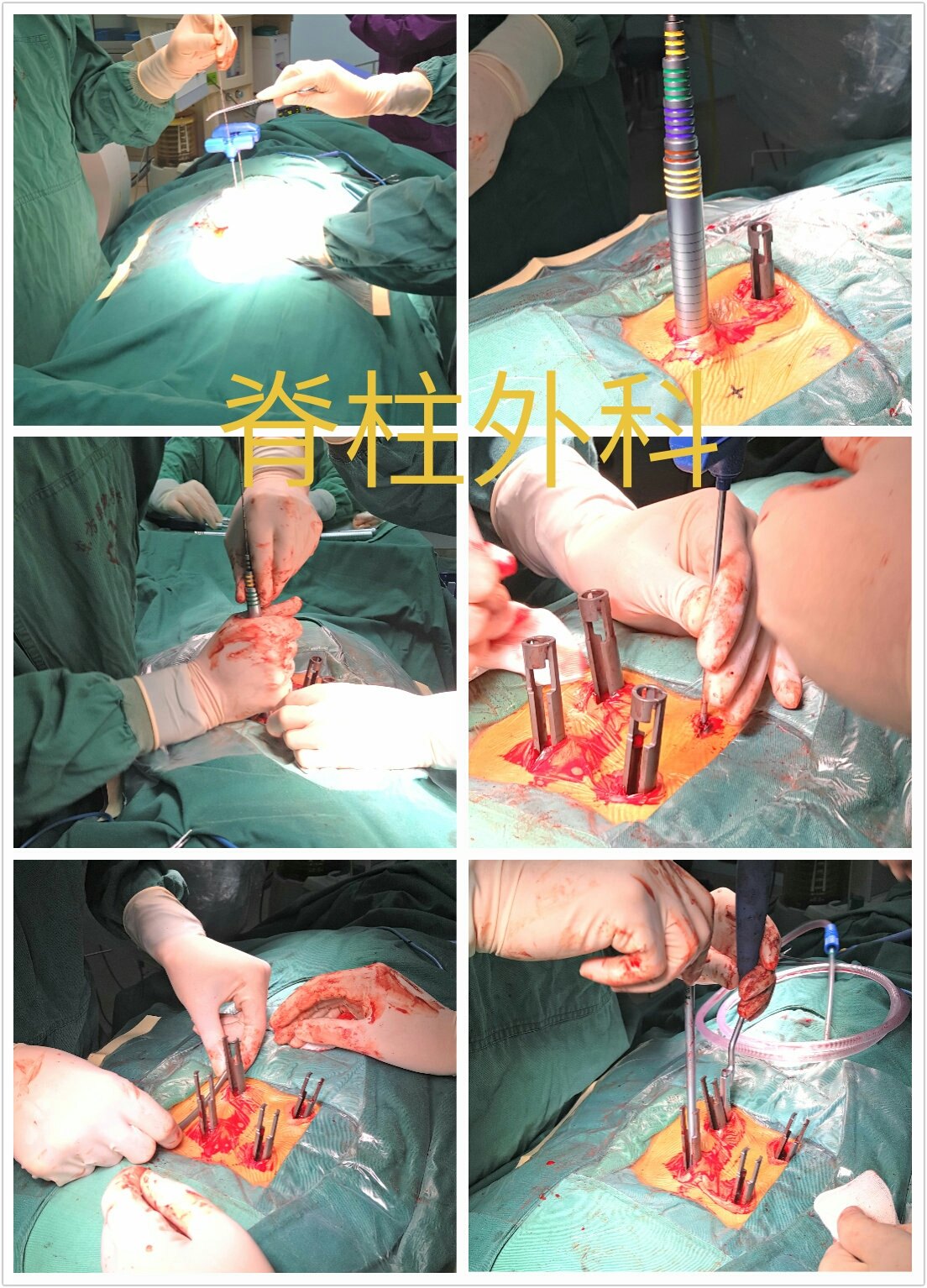 腰椎钉棒内固定术过程图片