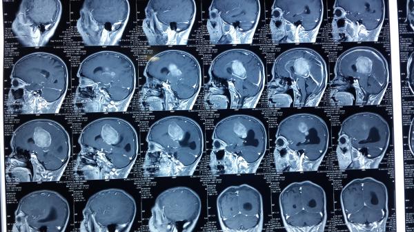 賀曉生教授左頂大腦鐮下腦膜瘤切除案例 - 微醫(掛號網)