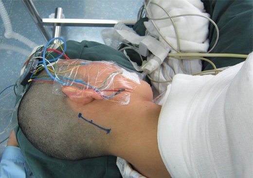 详解显微血管减压术治疗面肌痉挛优势