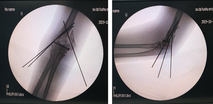 青少年t形髁间骨折的微创治疗闭合复位内外固定技术