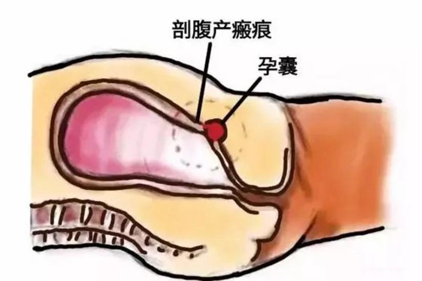 浅谈剖宫产瘢痕部位妊娠 健康号 微医