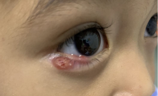 切除,大部分孩子皮肤面会完美愈合,极少数孩子是疤痕体质可能会有疤痕