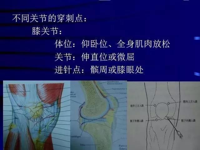 关节穿刺各关节腔穿刺方法技巧大全