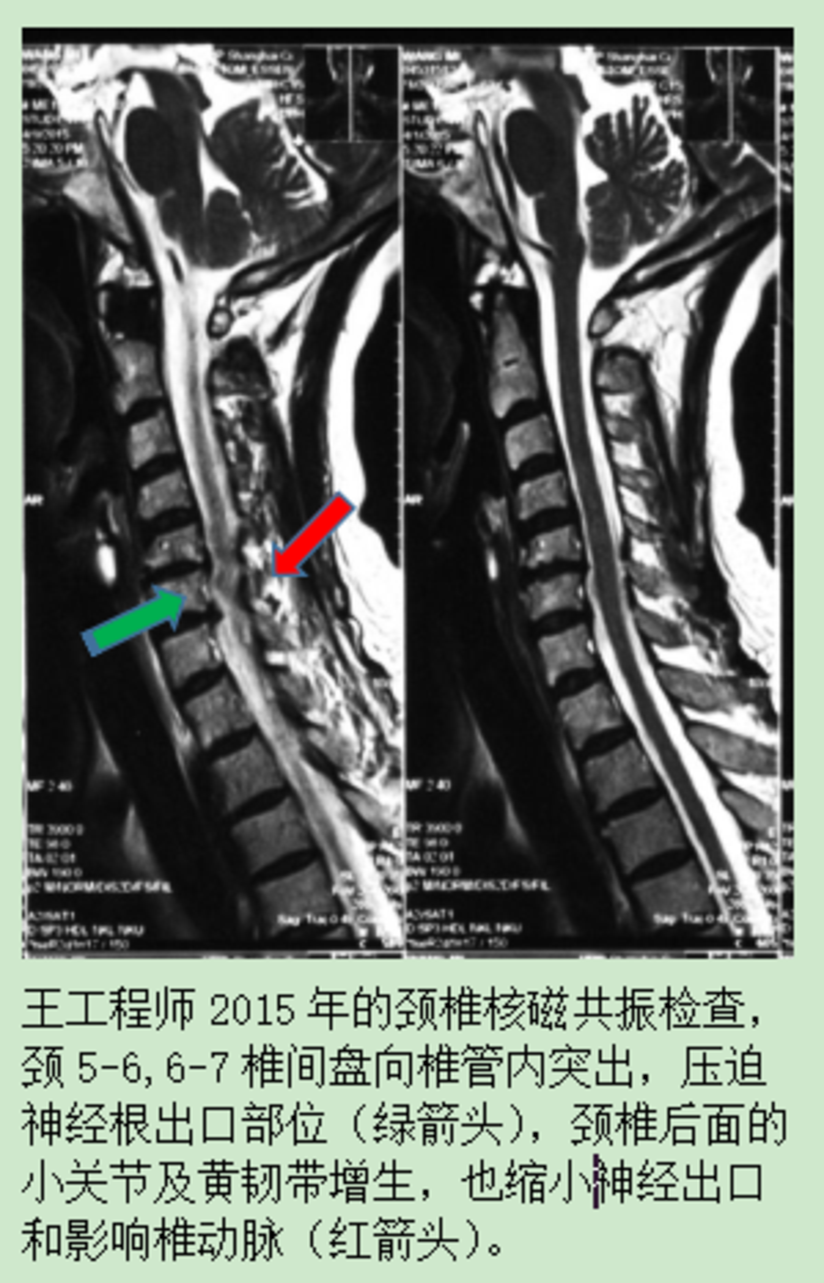 慢性颈腰痛的功能训练复健避免复发加重 病例介绍 健康号 微医