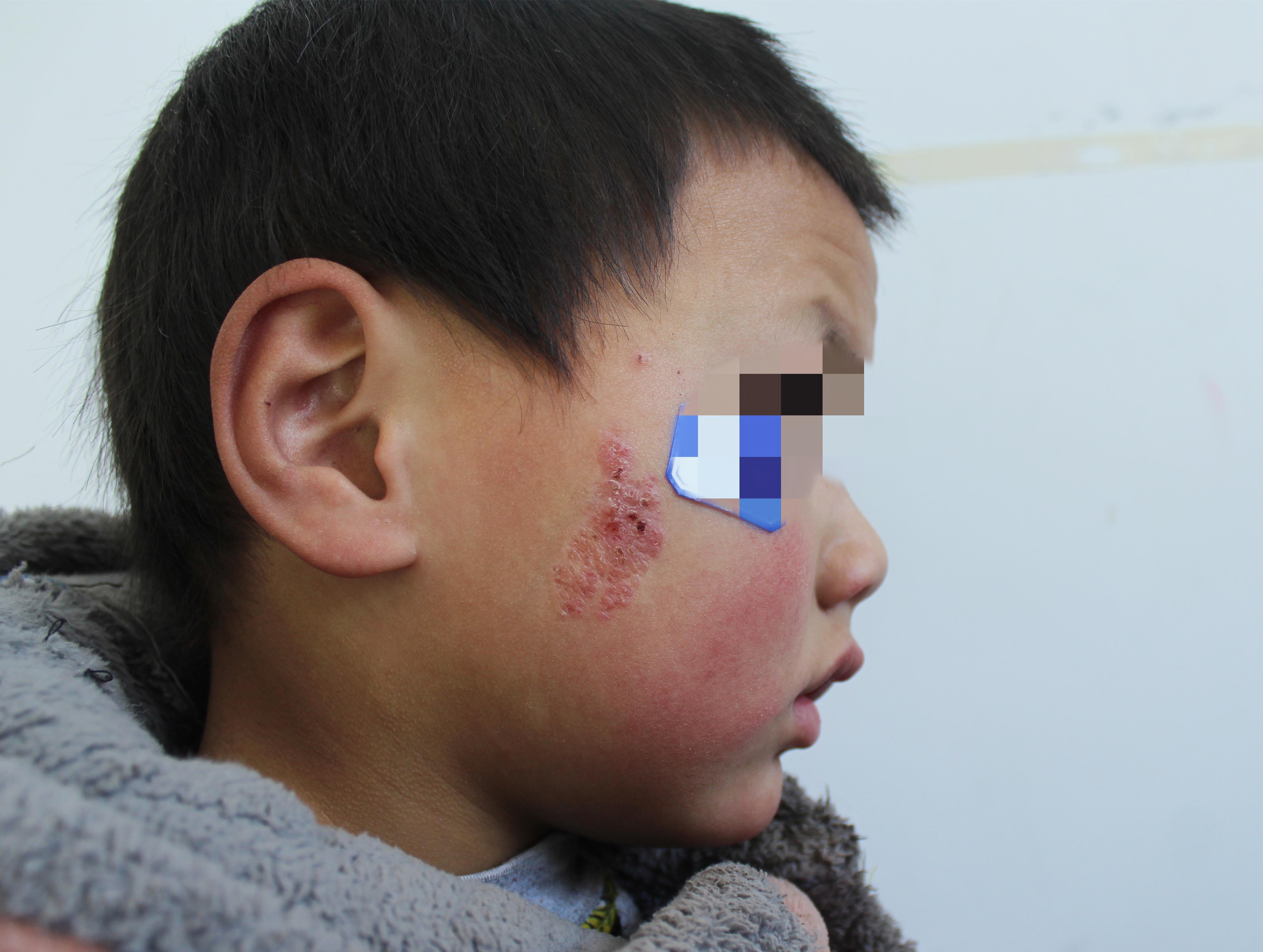 4岁男孩面部疯涨的皮脂腺痣