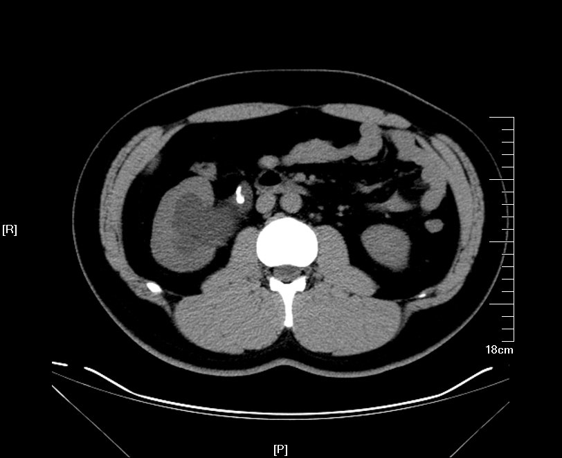 微创治疗上尿路结石的发展方向输尿管软镜