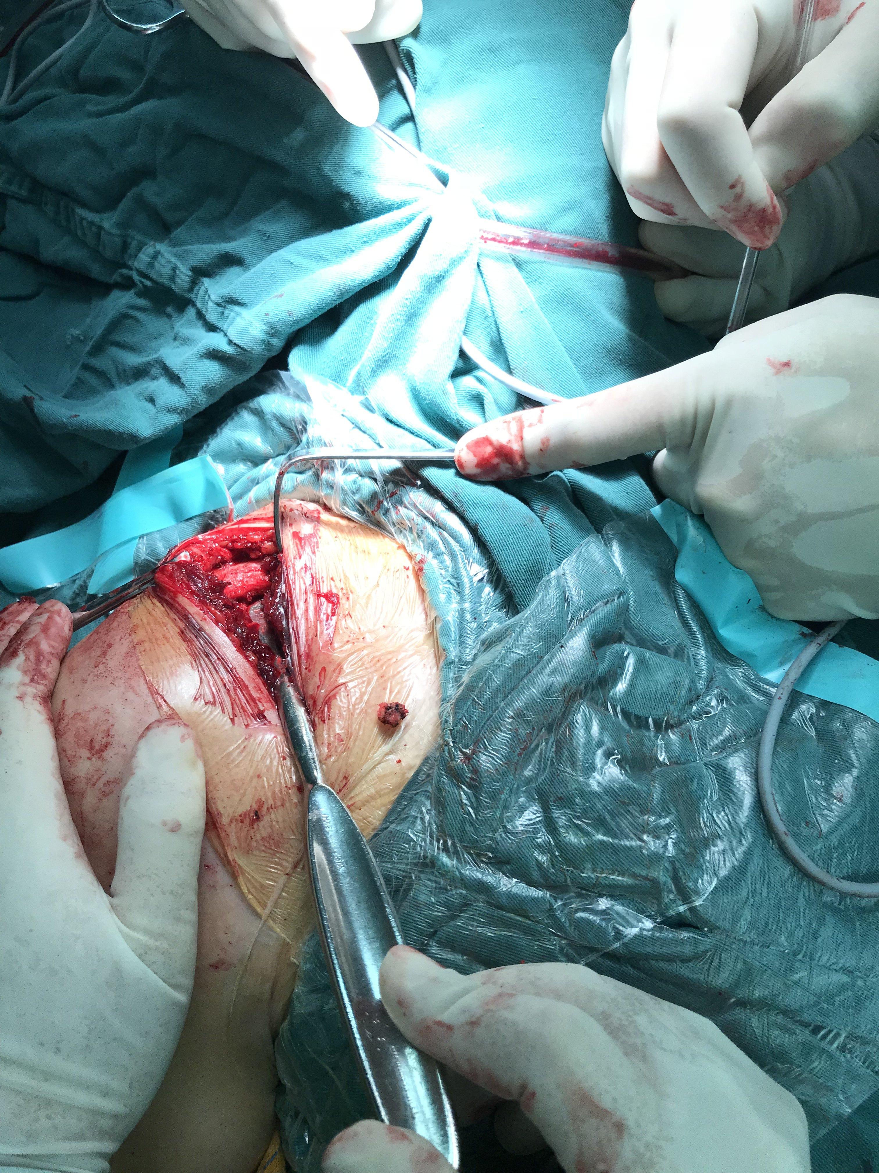 胸锁关节脱位手术步骤图片