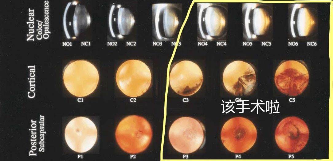 如何判断自己的白内障是在什么程度该不该手术白内障是怎么分期的