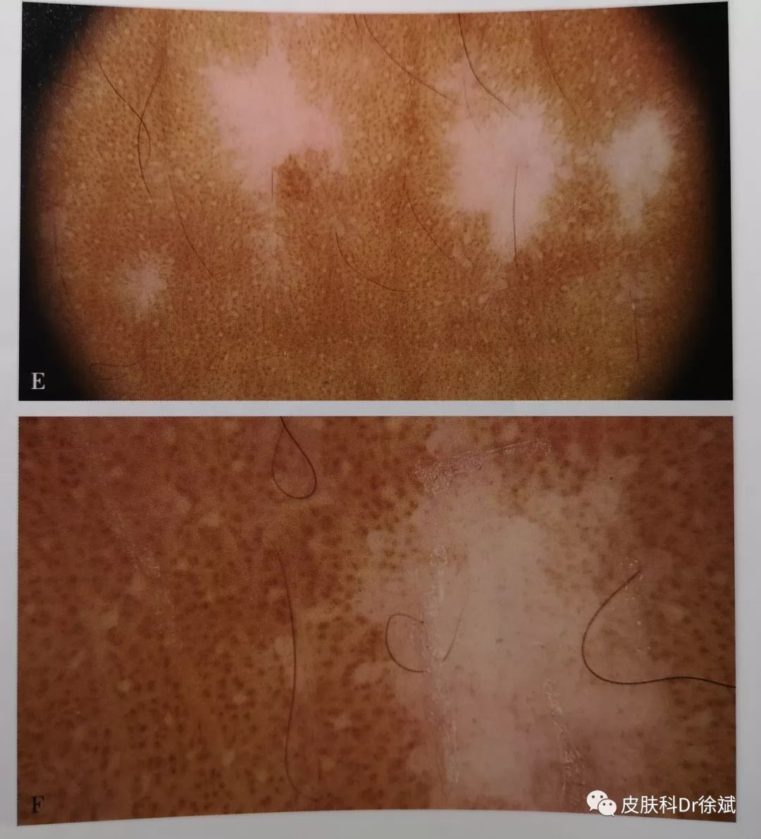 262丨识别早期白癜风的潜望镜偏振光皮肤镜