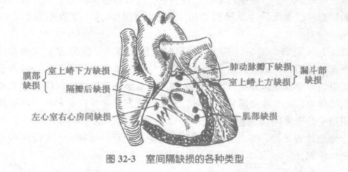 室间隔缺损最常见的先天性心脏病