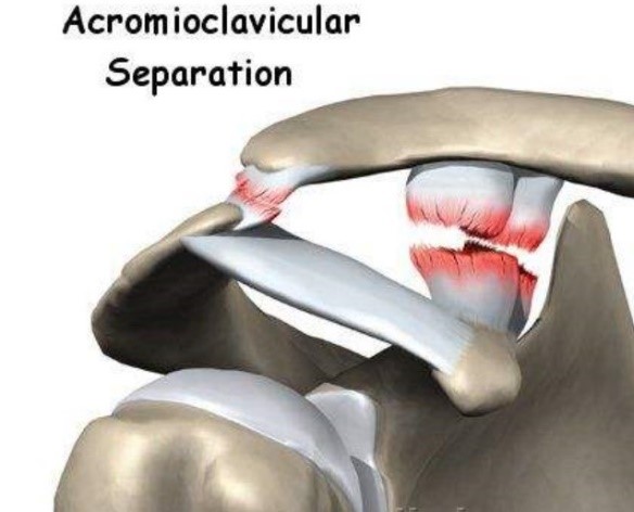 而一旦他们出了问题,锁骨远端就会挣脱束缚,无拘无束的翘了起来.