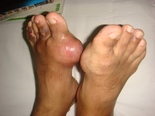 早期防治痛风的重要性