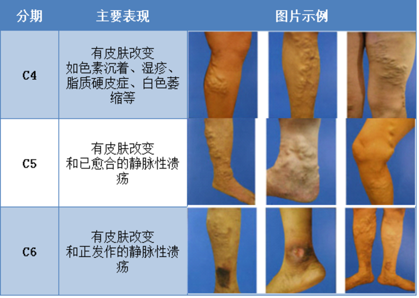 治疗下肢静脉曲张 保守还是手术 健康号 微医
