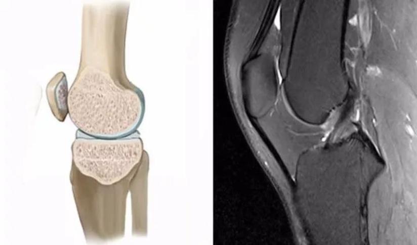 膝关节外伤 对膝关节损伤诊断极为重要的外伤性骨髓水肿 健康号 微医