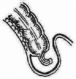 腹股沟滑动疝slidinginguinalhernia