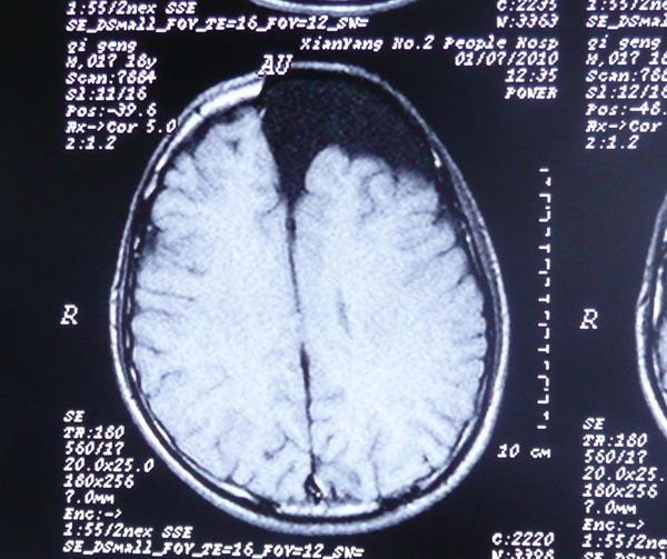 西京医院巨大蛛网膜囊肿治疗实例图组
