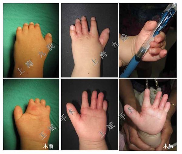 短指畸形的治疗