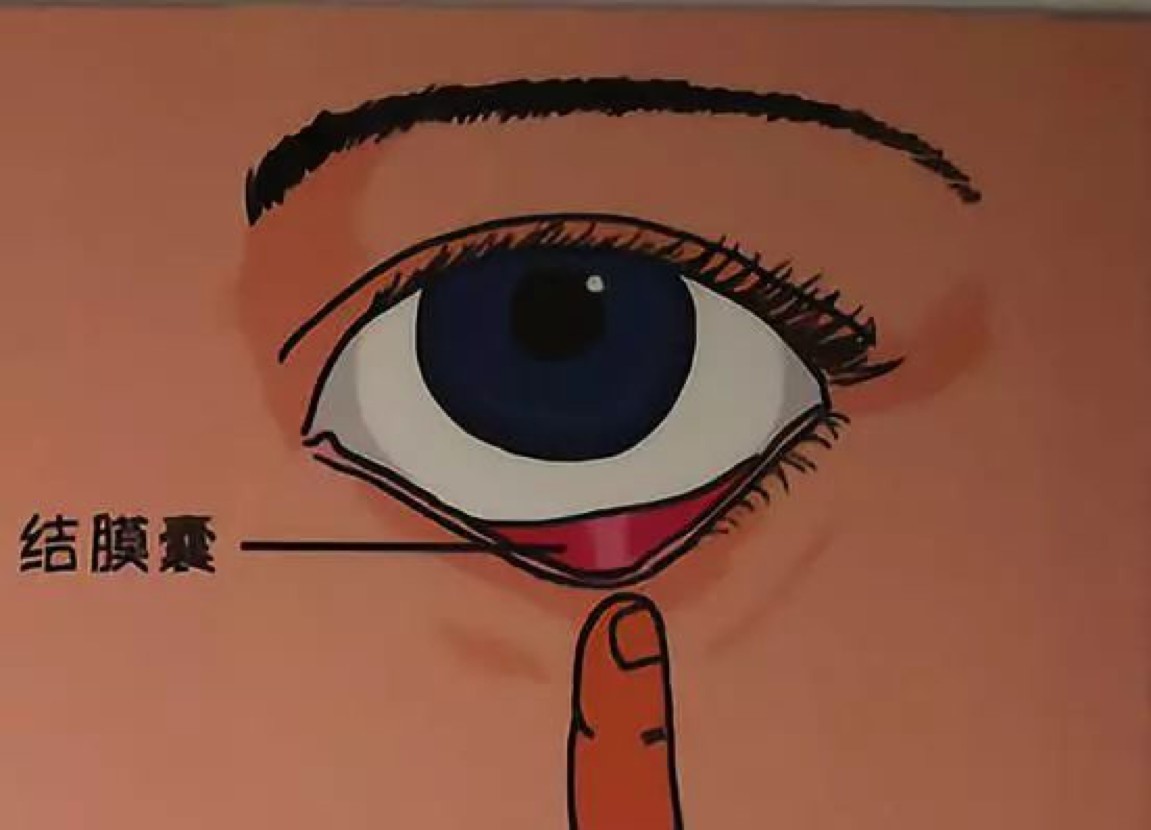 滴眼药水的正确姿势你get到了吗