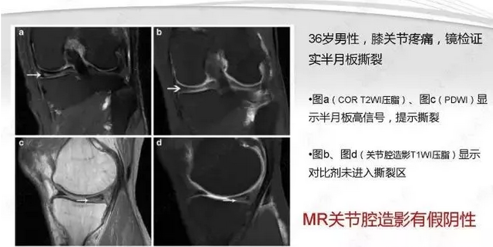 半月板半月板損傷的mri診斷