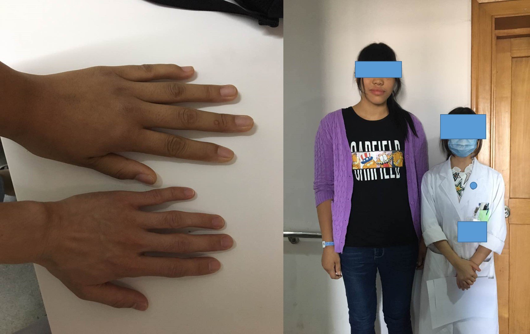 gh型垂体腺瘤肢端肥大症的诊断和治疗