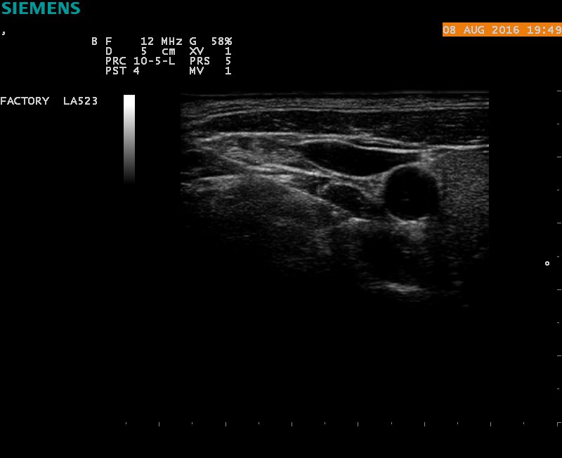 超声引导星状神经节阻滞sgb