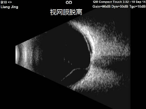 孔源性视网膜脱离